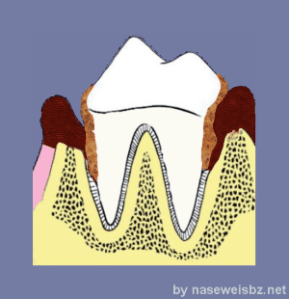Grafik Beginnende Parodontitis