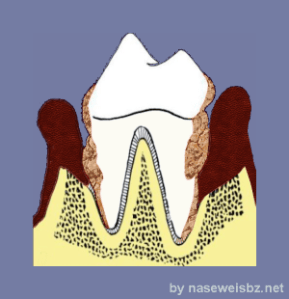 Grafik Hochgradige Parodontitis