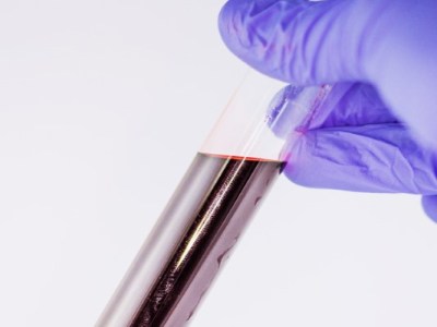 Blutproben: Fallstricke vermeiden